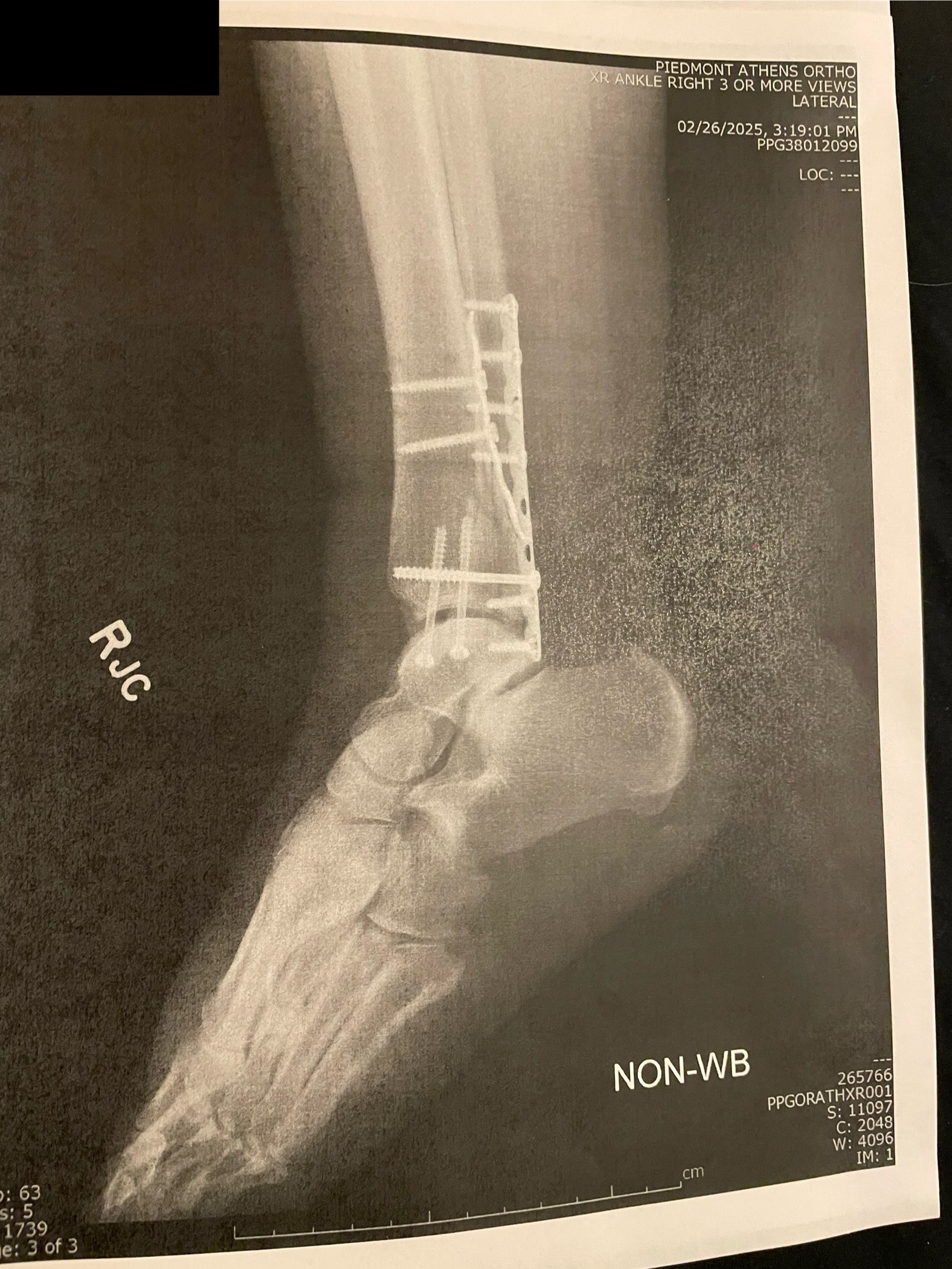 X-Ray of ankle with hardware including plates and screws that were put in during ORIF surgery